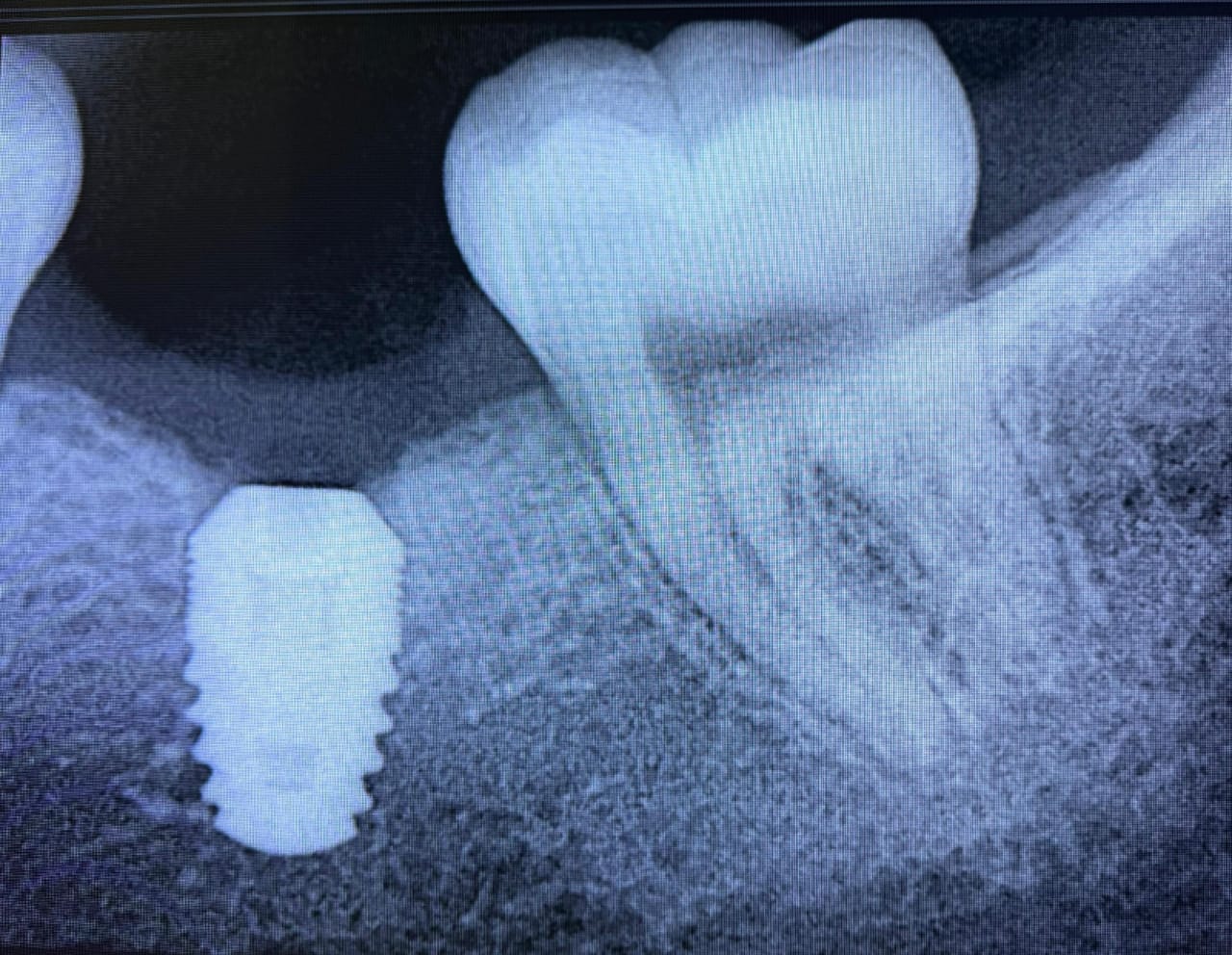 After procedure Xray of Implant